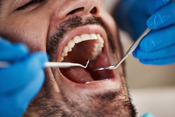 Best Emergency Dentist for Knocked-Out Tooth in Akron, OH